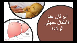 اليرقان (الاصفرار) و ارتفاع البيليروبين عند الأطفال حديثي الولادة/ Jaundice and elevated bilirubin