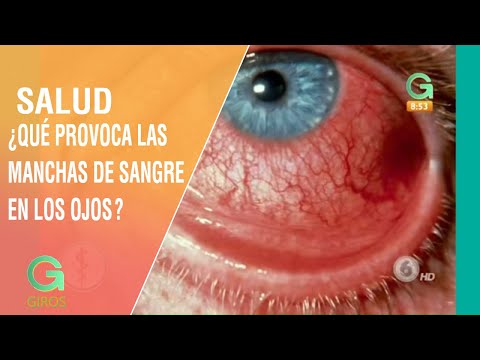 Vídeo: Mancha Roja En El Ojo: Cuándo Ver A Un Médico, Causas, Tratamiento Y Más