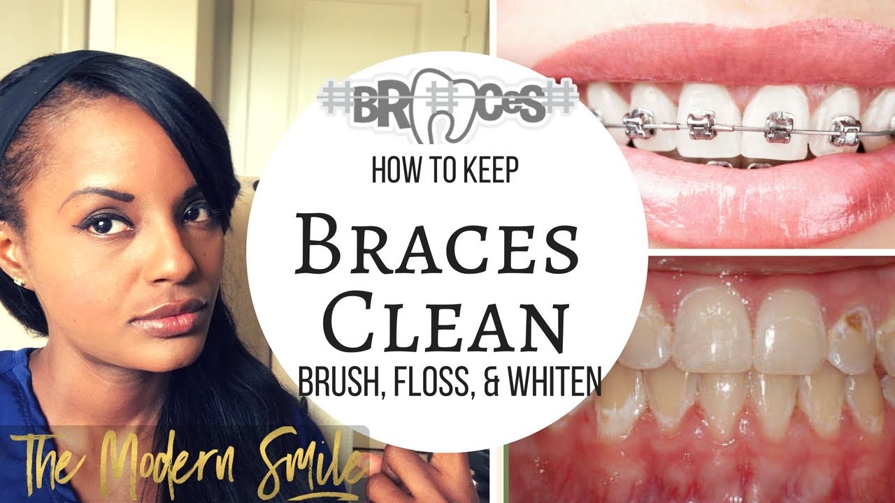5 tips to keep your BRACES CLEAN and How to FLOSS, AND WHITEN while