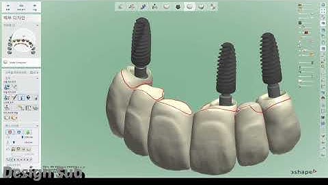 3shape design (anterior teeth 😬 implant case 6 units,  osstem implant)
