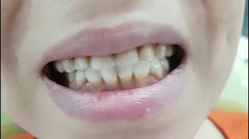 Tự tin nở nụ cười xinh với hàm răng bọc sứ