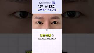 눈이 처지고 반쯤 감긴 눈동자를 보이게 하고 싶어요!   | 제이준 성형외과