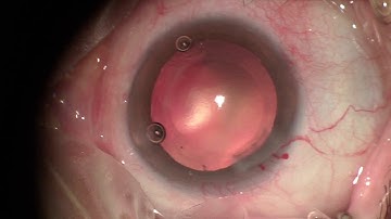 Tilt and tumble technique - Cataract Surgery