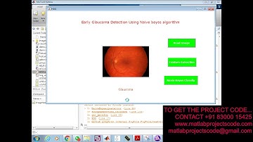 Early Glaucoma Detection Using Naive bayes algorithm