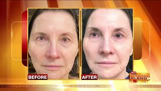NeoGen Plasma Treatment DaybyDay Results & Recovery with Dr. Manjoney | Morning Blend