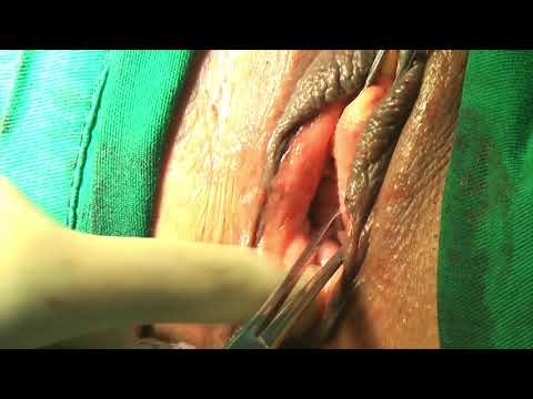Sling e perineoplastia / Sling and perineoplasty