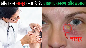 आँखों से पानी आने के कारण और उपचार | आँख के नासूर का इलाज- नाक से दूरबीन द्वारा ऑपरेशन | JDH