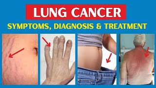 Lung Cancer Warning Signs YOU SHOULDN'T IGNORE (Lung Carcinoma Symptoms, Diagnosis \& Treatments)