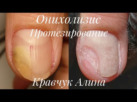 Онихолизис. Протезирование с помощью геля GEHWOL.