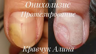 видео: Онихолизис. Протезирование с помощью геля GEHWOL. картинка: Онихолизис. Протезирование с помощью геля GEHWOL.