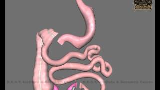 diverted ileal interposition