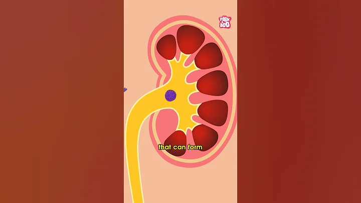What Causes Kidney Stones? | World Kidney Day Special #shorts #kidneystone #worldkidneyday