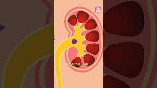 What Causes Kidney Stones? | World Kidney Day Special #shorts #kidneystone #worldkidneyday