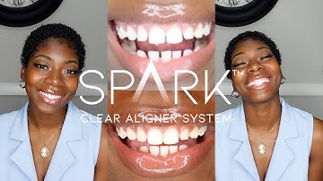 Spark Clear Aligner update! Progress pictures, oral hygiene, pain level, what I eat, & aligner hacks