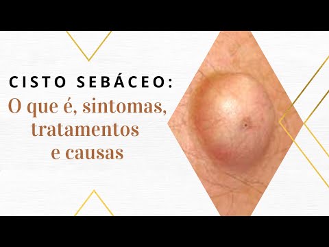 Cisto sebáceo: O que é, sintomas, tratamentos e causas