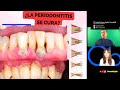 ¿LA PERIODONTITIS SE CURA?