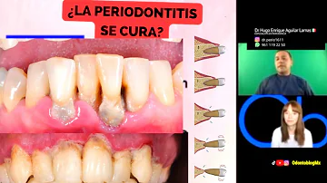 ¿Hay esperanza para la periodontitis?