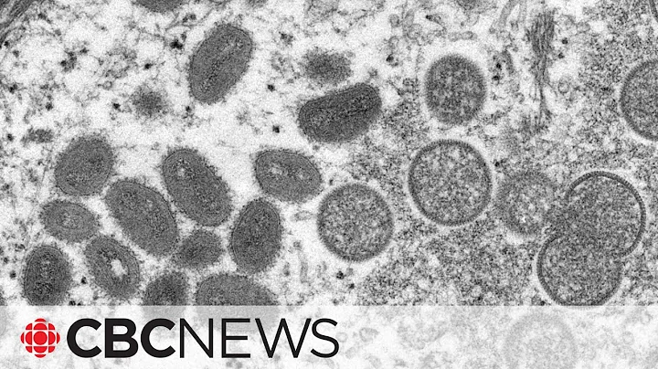 Monkeypox not the same as COVID-19, says expert - DayDayNews