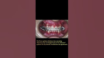 Forsus Fatigue resistant Appliance - Class II corrector