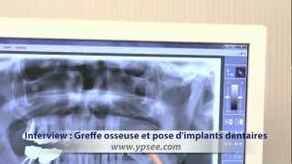 Implant dentaire en Hongrie : greffe pré-implantaire expliquée par le Doc !