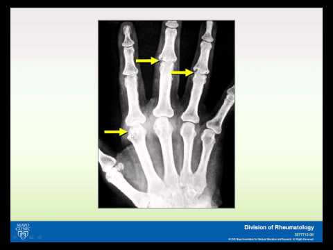 Video: Verschil Tussen Lupus En Reumatoïde Artritis