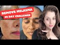 How to remove melasma at home  30 day challenge  nipun kapur