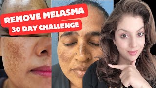 How to remove Melasma at home | 30 day challenge | Nipun Kapur