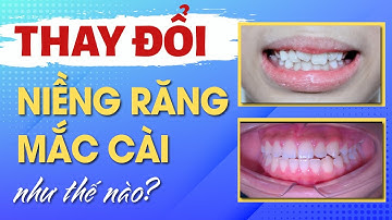 Răng Lệch Lạc Và Sự Thay Đổi Khi Niềng Răng Mắc Cài | Nha khoa Đặng Xá - S-Dental