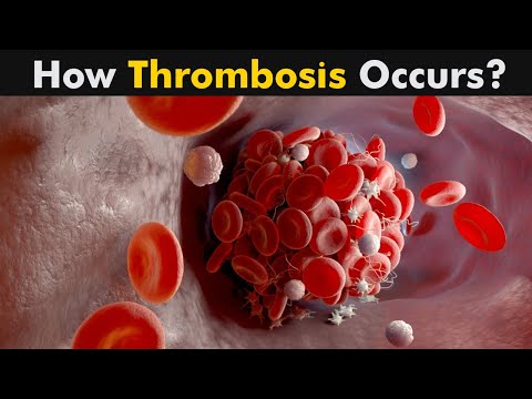 Thrombosis 3D Animation | Deep Vein Thrombosis ; Symptoms , Causes and Treatment (Urdu/Hindi)