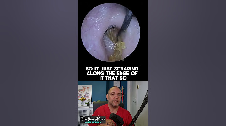 Huge skin ribbon pulled from the ear! #earwax #ear #satisfying  nurse #audpeeps #earwaxremoval