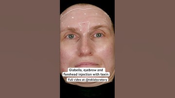 #botoxinjections for glabella, eyebrow and forehead to reduce wrinkles. ATA Glasgow #botoxtraining