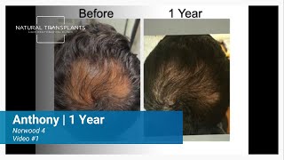 Norwood 4 Hair Transplant, Crown and Hairline 1 Year Results | Dr. Blumenthal (Anthony)
