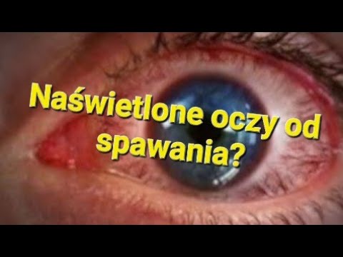 Wideo: Oparzenie Oczu Przez Spawanie