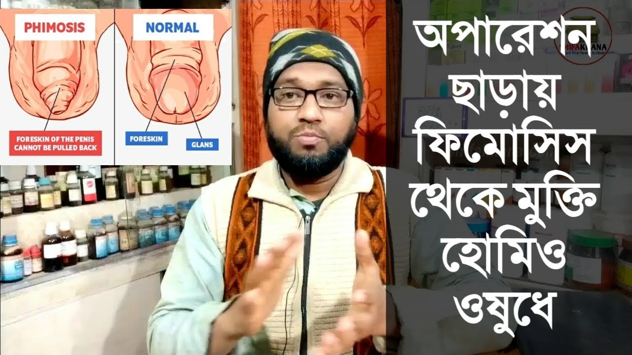 অপারেশন ছাড়ায় ফিমোসিস থেকে মুক্তি হোমিও ওষুধে | phimosis homeopathic medicine