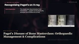 Paget's Disease of Bone Masterclass: Orthopaedic Management & Complications