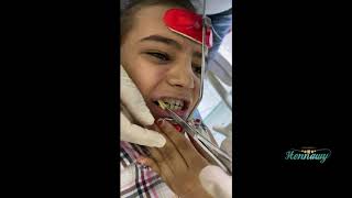 (orthodontic )facemask installation