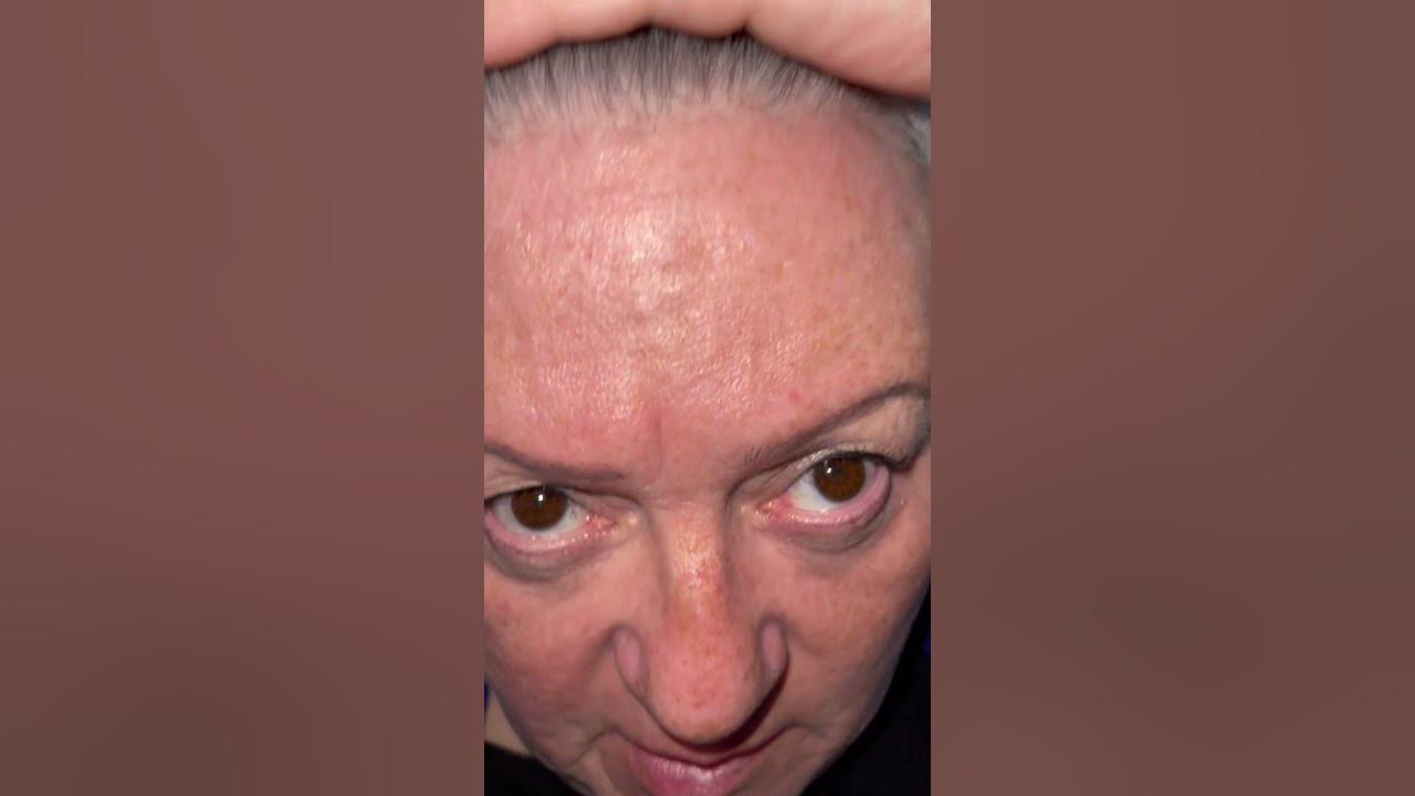 5-1-23-my-face-and-neck-burnt-swollen-from-being-targeted-with