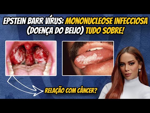 EPSTEIN BARR VÍRUS: Mononucleose infecciosa (doença do beijo), tudo sobre! #linfoma #anitta