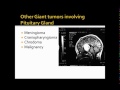 Skull Base Approaches for Giant Pituitary Tumors