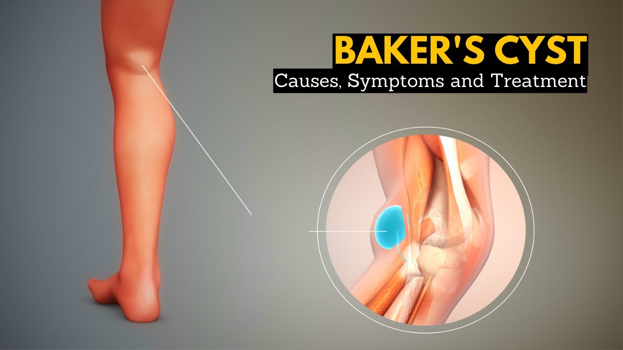 Download Baker's Cyst, Causes, Signs and Symptoms, Diagnosis and Treatment.