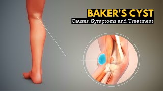 Baker's Cyst, Causes, Signs and Symptoms, Diagnosis and Treatment.