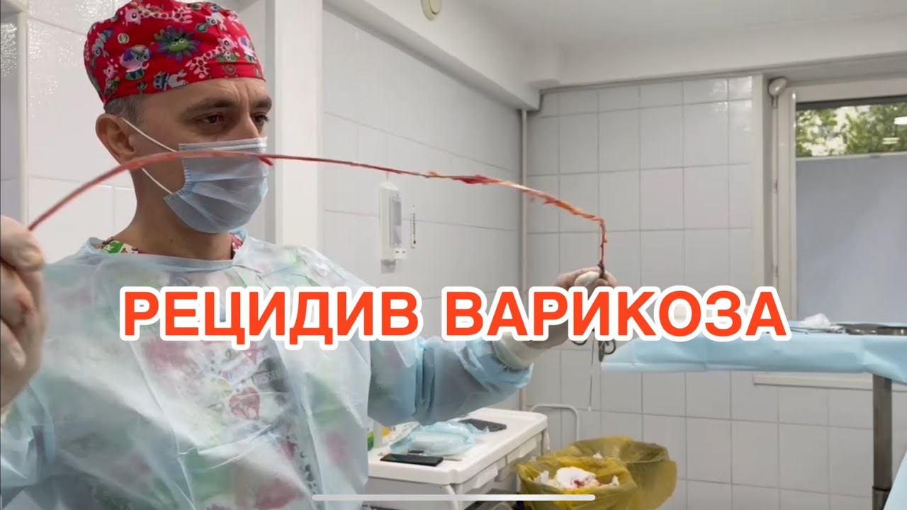 РЕЦИДИВ ВАРИКОЗА после операции. ФЛЕБОЛОГ МОСКВА. Флеболог. Лечение ...