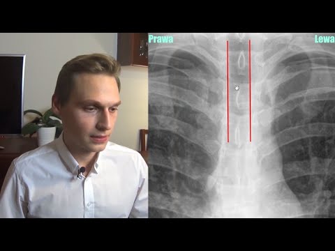 Wideo: RTG POChP: Zdjęcia, Diagnoza I Nie Tylko