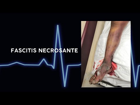 Vídeo: Fascitis Necrosante: Causas, Síntomas Y Tratamiento