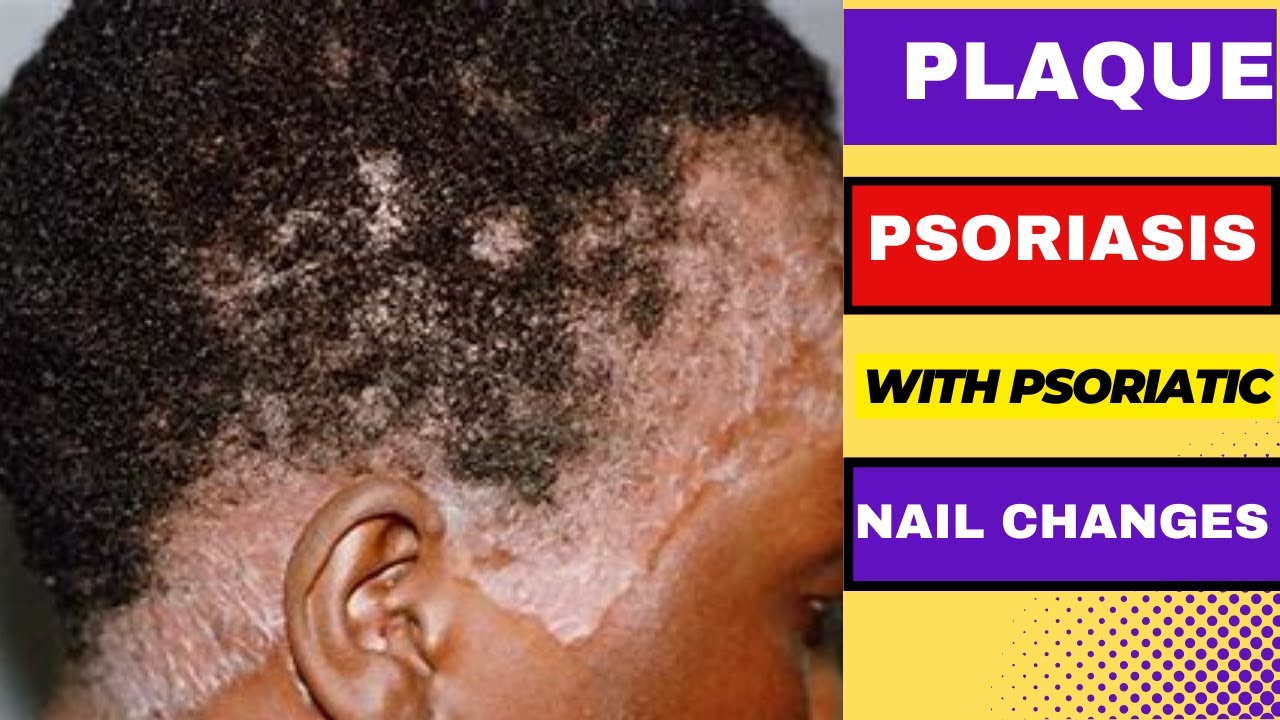 Plaque Psoriasis with Psoriatic nail changes nail changes in plaque