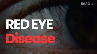 EXPLAINER: The Red Eye Disease: Please don't ignore!