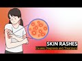 Skin rash causes signs and symptoms diagnosis and treatment