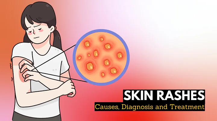 Skin Rash, Causes, Signs and Symptoms, Diagnosis and Treatment. - DayDayNews