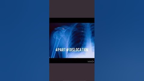 4 part fracture dislocation of Shoulder in 31 yr old