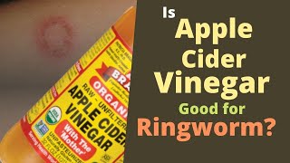 Apple Cider Vinegar for Ringworm [Does It Kill Ringworm?]